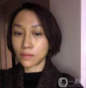 做熱瑪吉過后，臉是又白嫩又Q彈