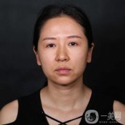 做完拉皮手術(shù)有10多天的時(shí)間，臉上的除皺皮膚緊致效果顯著
