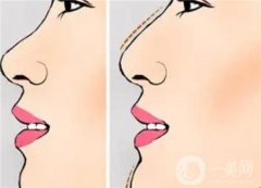 隆鼻：那么多求美者捧輕醫(yī)美的香氣 傳統(tǒng)醫(yī)美要怎么香
