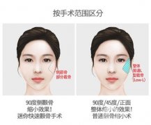 顴骨縮小手術(shù)的適應(yīng)對(duì)象