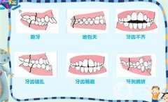 牙齒矯正會(huì)改變臉型嗎