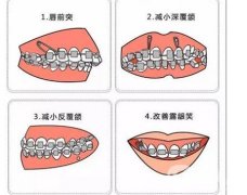 牙齒矯正會(huì)改變臉型么