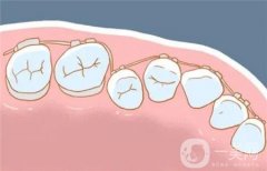 牙齒矯正價(jià)格表和方法