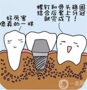 種牙全過程視頻