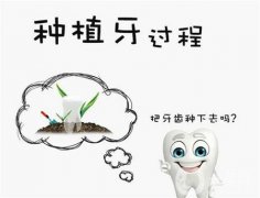種植牙需要幾次