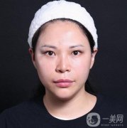 面部拉皮手術(shù)的第二天，臉上有強烈的緊繃感覺