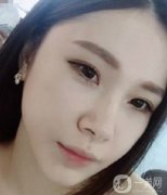 做了拉皮手術(shù)的第一天，自己的臉是真的腫