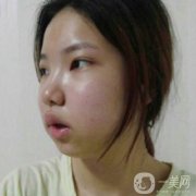 做了面部拉皮手術(shù)之后，感覺自己又回到了20歲的時候的肌膚