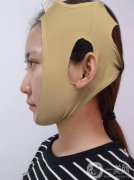 拉皮手術(shù)十六天了，恢復(fù)到現(xiàn)在已經(jīng)沒有那么的腫了