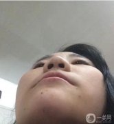 隆鼻術(shù)后兩個(gè)月，鼻子的高度剛剛好