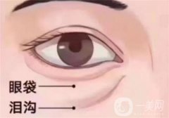 不開(kāi)刀怎么去眼袋