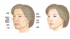 面部凹陷用什么產品恢復