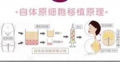面部玻尿酸填充能維持多久