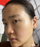 做完鼻子后，感覺效果出來了，鼻翼小很多