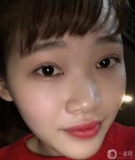 帶著一雙傷心的眼淚，鼻子手術終于結束了