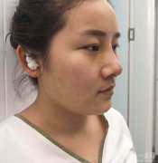 經(jīng)過一番思考，我終于決定做鼻子整形手術