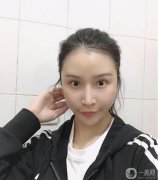 減脂很難，也瘦不了多少，所以面部吸脂真的幫了我很多