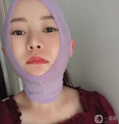 我在下部做了吸臉和線雕，解決了臉上脂肪厚度和皮脂下垂的問題