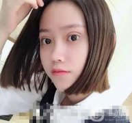 做完眼綜合手術(shù)已經(jīng)有二十多天的時(shí)間了，眼睛消腫得越來越快了