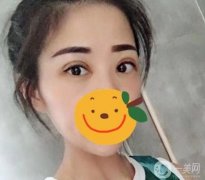 做雙眼皮手術的想法在我腦海里已經(jīng)存在很久了