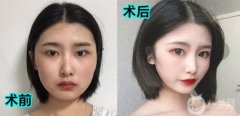 因?yàn)槲业难劬Σ恢罏槭裁纯雌饋砟敲床辉?，眼睛的長(zhǎng)和寬也不是我想要的