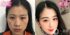 我一直不太喜歡我的大鼻子，它看起來又扁又平，沒有弧度