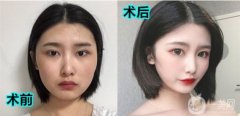 術(shù)后16天，拆線后眼睛真的恢復(fù)的比較快