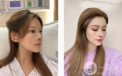 想了很久，攢了很久的錢(qián)，終于如愿在醫(yī)院做了個(gè)鼻子