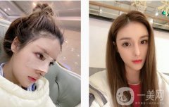 現(xiàn)在鼻子弧度還是很好的，山根自然消失，在原來的基礎(chǔ)上增加1 mm以上
