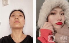 當(dāng)我做完眼部手術(shù)后，我會在打洗臉，而不是像往常一樣
