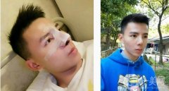 來(lái)醫(yī)院面診后，醫(yī)生給我做鼻子合成的建議，腫脹的耳軟骨墊托起了鼻子鼻頭縮