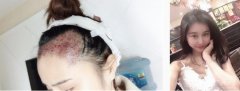 種發(fā)際線(xiàn)一直是我想做的事，但我不敢做