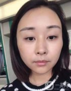 面診時(shí)醫(yī)生說面部凹陷相當(dāng)明顯，尤其是臉頰、太陽穴、額頭