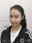 我早就想做面部吸脂了，我去過(guò)很多家，也咨詢過(guò)醫(yī)院