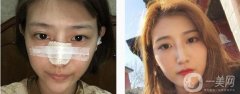 所以很多人對(duì)自己的鼻子不滿意，甚至有人選擇做隆鼻來(lái)達(dá)到美觀的效果