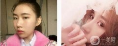 我做了一次全面的鼻子整形手術(shù)，因?yàn)槲铱傆X得鼻子塌在山根，整個(gè)鼻子看起來