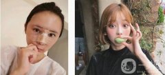 之前想了很久，由于實(shí)在不喜歡自己的鼻子，影響了自己的整體形象，所以來做