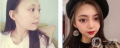 一直對(duì)自己的鼻子不是特別滿意，后來查了很多醫(yī)院才決定來這一家