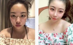 醫(yī)生說我的鼻子需要抬高鼻梁，然后縮小鼻子