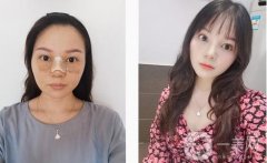 鼻梁很低，鼻翼很寬，從正面和側(cè)面看，這都是一個(gè)合適的塌鼻子