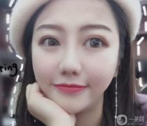手術前鼻子不高，總覺得鼻子不好看