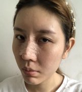 在網(wǎng)上查了很多隆鼻的資料，看到了各種鼻子類型