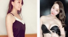 假體隆胸后一個(gè)月，現(xiàn)在有了漂亮性感的乳房，穿性感吊帶就沒壓力了