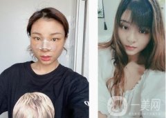 隆鼻第一天，迫不及待的想和大家分享