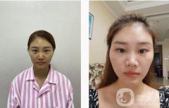 埋線(xiàn)雙眼皮手術(shù)后，我覺(jué)得每天照鏡子成了我不可或缺的例行公事.