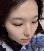 。手術前我是單眼皮純，沒有雙眼皮的痕跡，我一直夢想如果我有雙眼皮