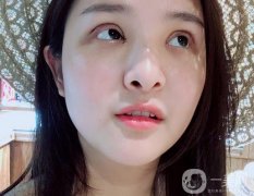一定要特別注意雙眼皮的恢復期，說怎么剪雙眼皮的睫毛，怎么讓睫毛更長更密