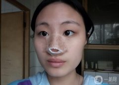 鼻子塌了，鼻子寬了，臉看起來扁扁的，不立體，一直想要個(gè)高鼻子