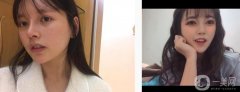 光子嫩膚后一個月，發(fā)現(xiàn)身邊有朋友一直在做光子嫩膚，女生對美妝項目毫無抵