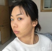 線雕完第七天了，現(xiàn)在臉上的針眼還看得見，但是結(jié)痂了